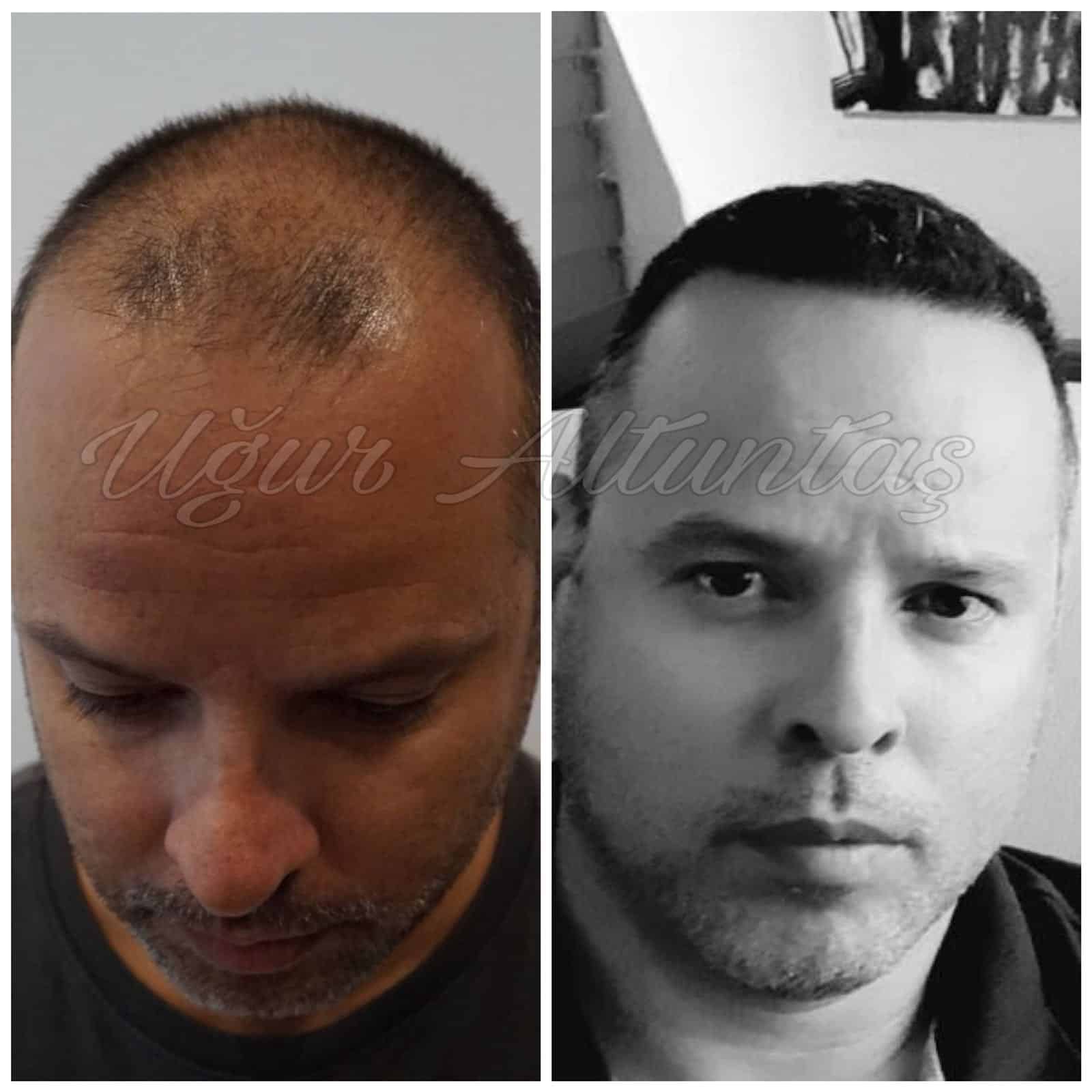 Global-health-fue-before-after-1