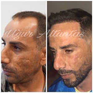 Global-health-fue-before-after-3