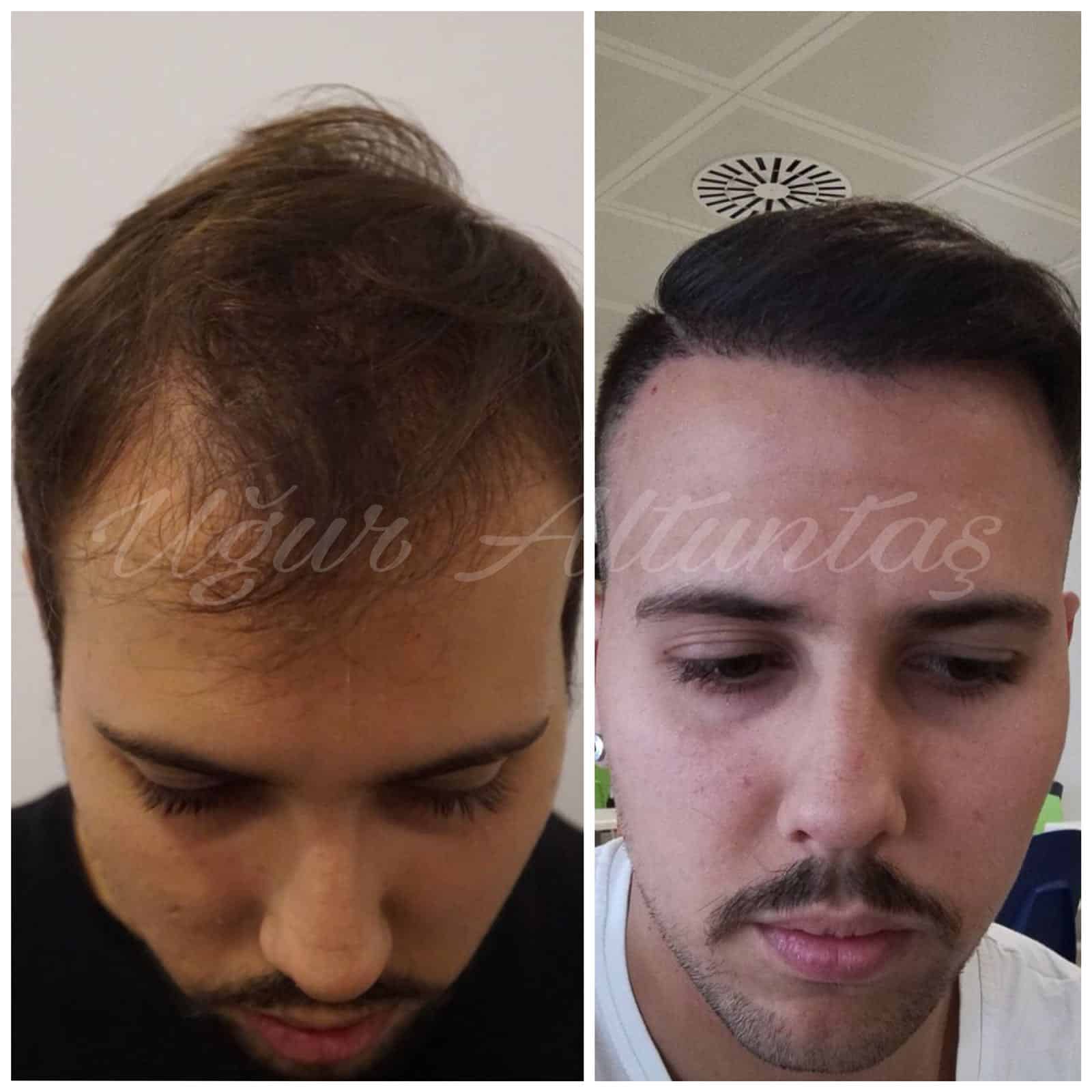 Global-health-fue-before-after-4