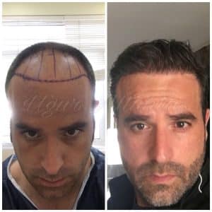 Global-health-fue-before-after-5
