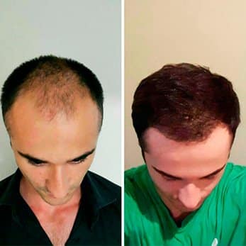 Injerto capilar resultados (2)