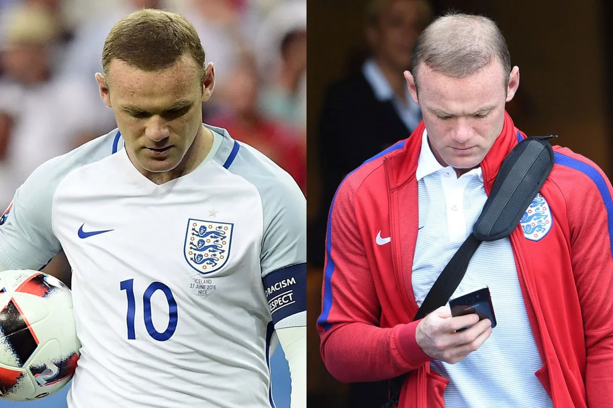 Wayne Rooney injerto capilar antes y después