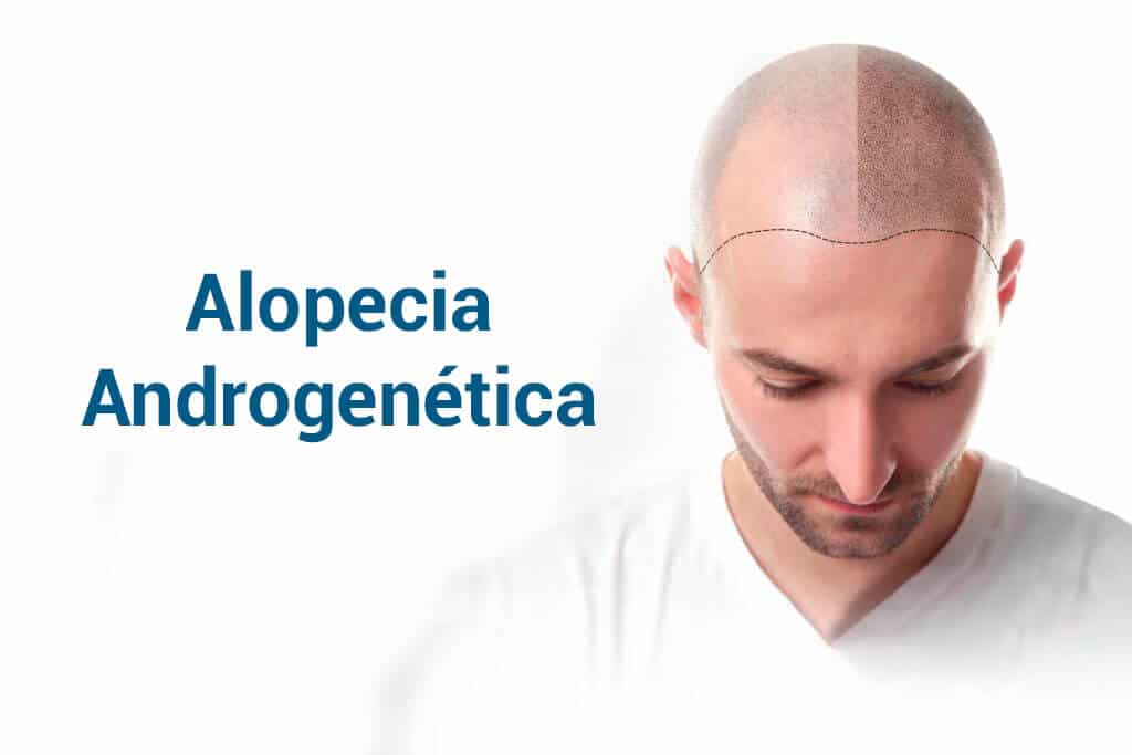 Alopecia androgenética
