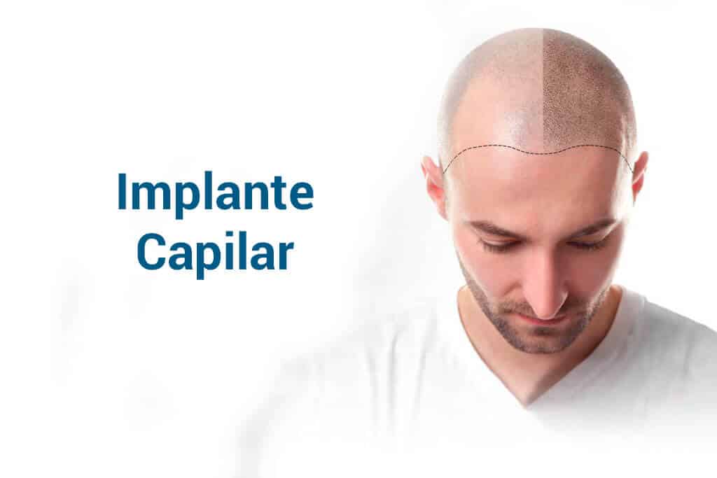 Implante capilar
