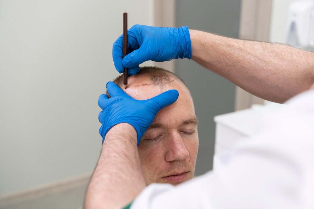 Trasplante de cabello: ¿Es un procedimiento doloroso?