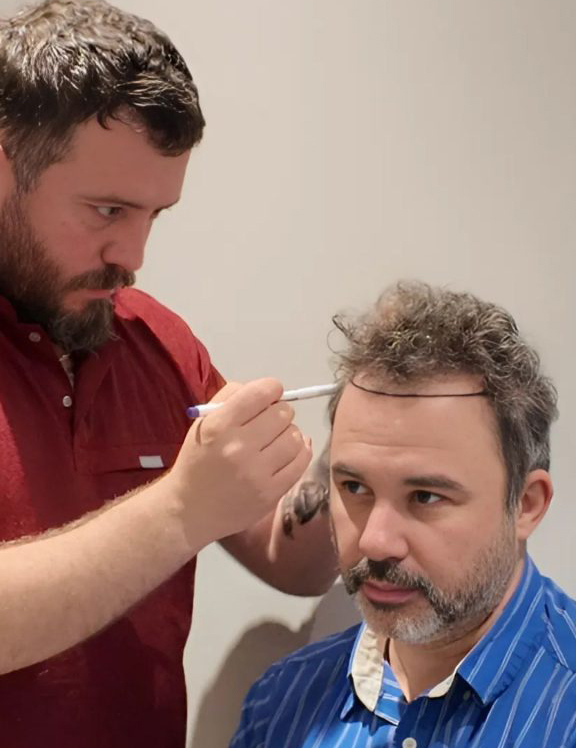 Transplante pelo turquia calidad