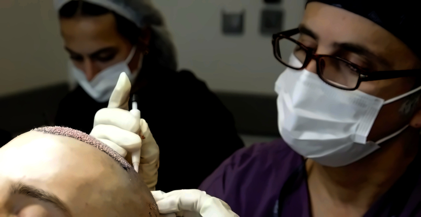 Trasplante de pelo en turquia